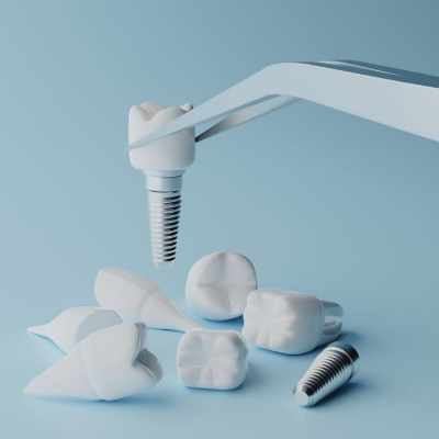 Mise en place des implants dentaires